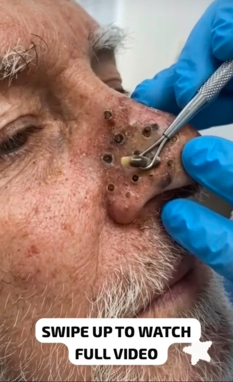 The Truth Behind Stubborn Blackheads: Causes, Safe Removal, and Expert Skin Care Tips Watch Full Video Below