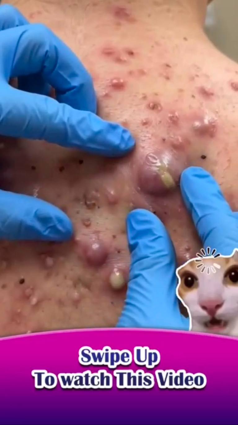 Severe Cystic Acne on the Back: Understanding Painful Skin Bumps, Causes, and Modern Treatment Options