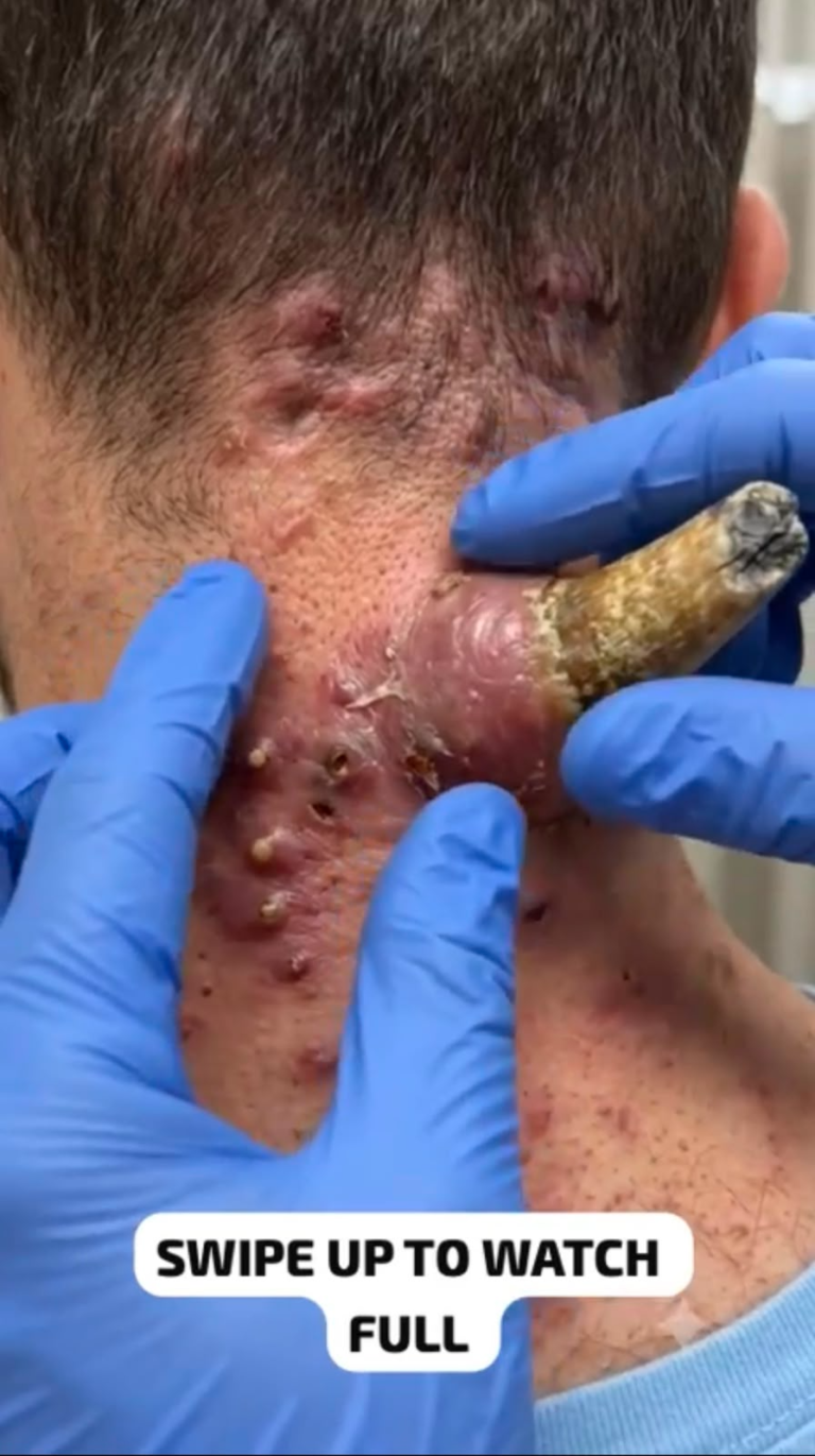 Giant Neck Cyst: Causes, Symptoms, Safe Treatment, and Why Professional Removal Matters