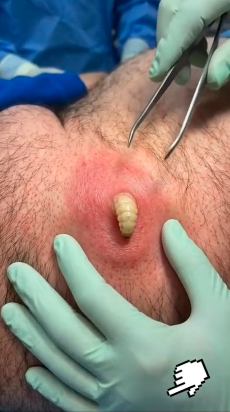 Painful Skin Boil or Infected Cyst? Causes, Symptoms, Safe Treatment, and Prevention Guide