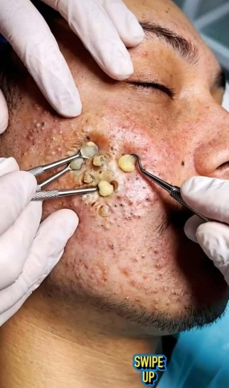 Giant Blackheads and Large Sebaceous Cysts: Causes, Treatment, and Safe Removal