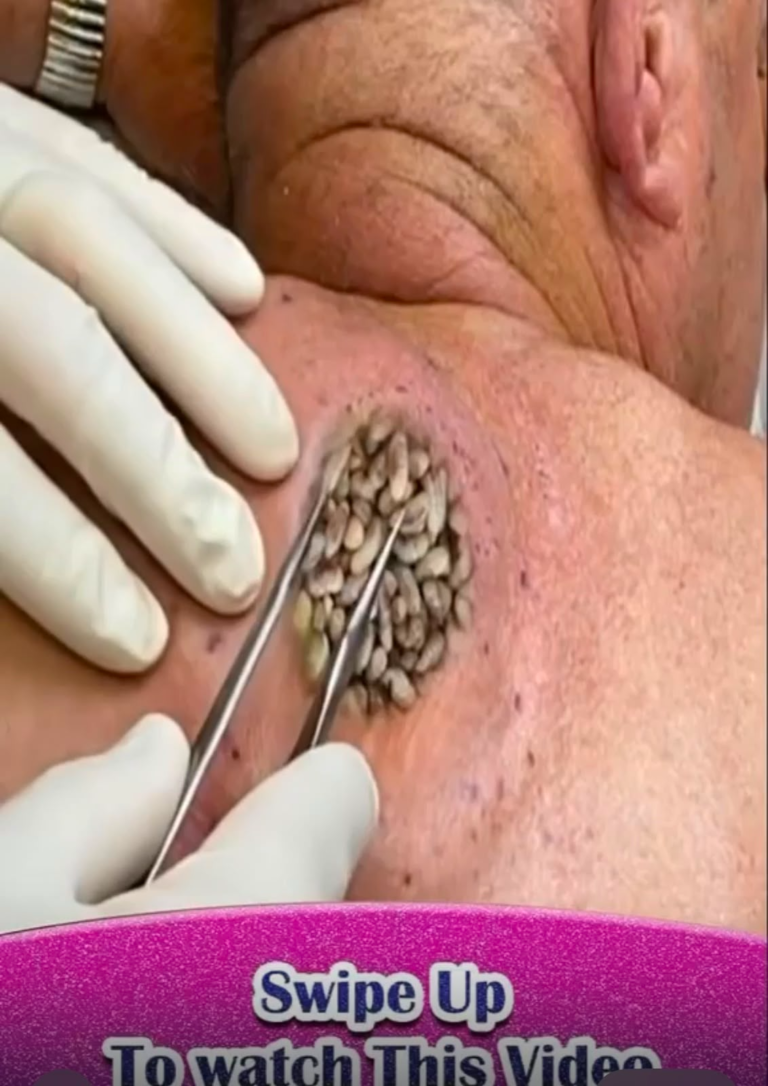 Giant Cluster of Epidermoid Cysts on the Shoulder: Causes, Symptoms, Treatment & Prevention