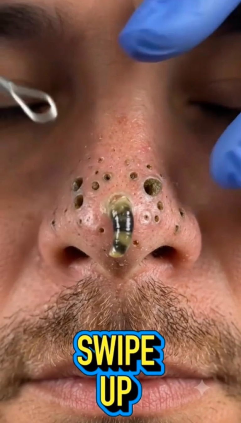 Massive Blackhead & Dilated Pore Extraction on the Nose: Causes, Treatment, and Prevention