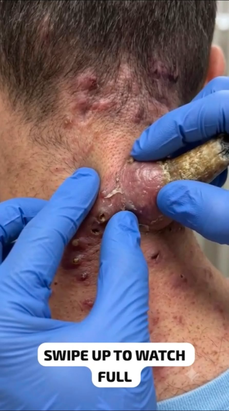 A Massive Neck Cyst That Shocked Millions: Understanding Severe Skin Cysts and Safe Treatment Options Watch Full Video Below