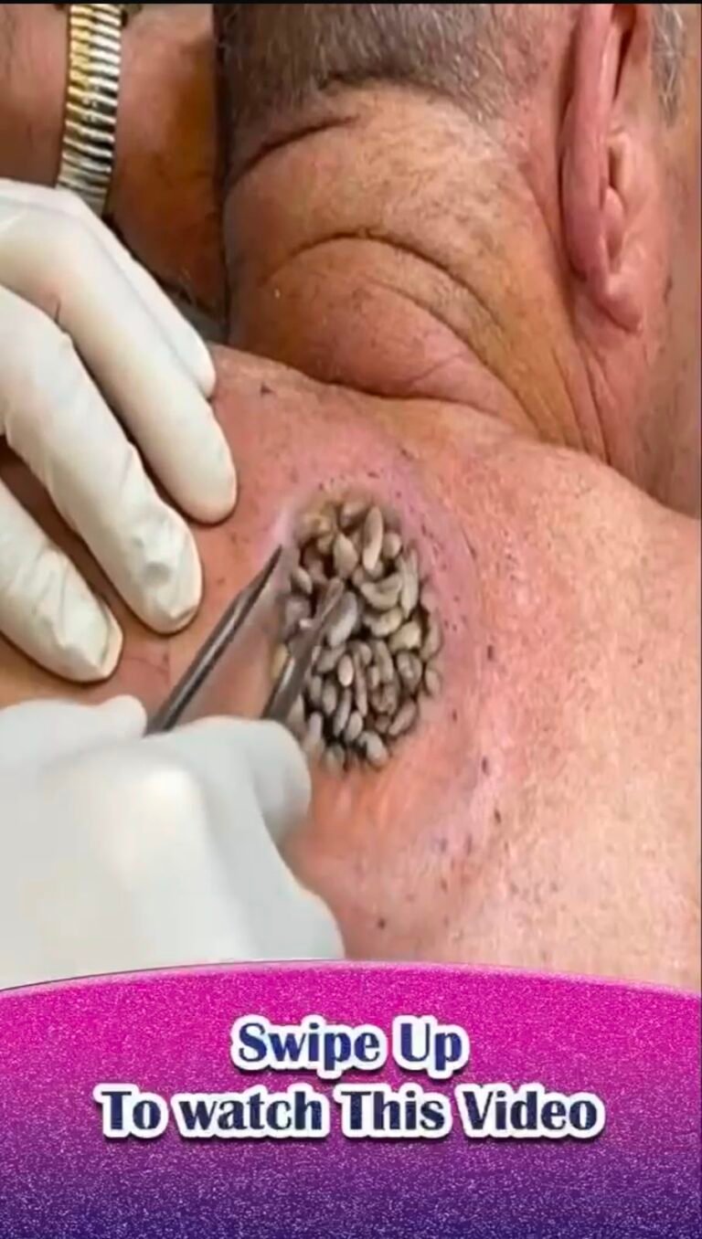 Cluster of Engorged Ticks on the Shoulder: Causes, Safe Removal, Risks, and Prevention