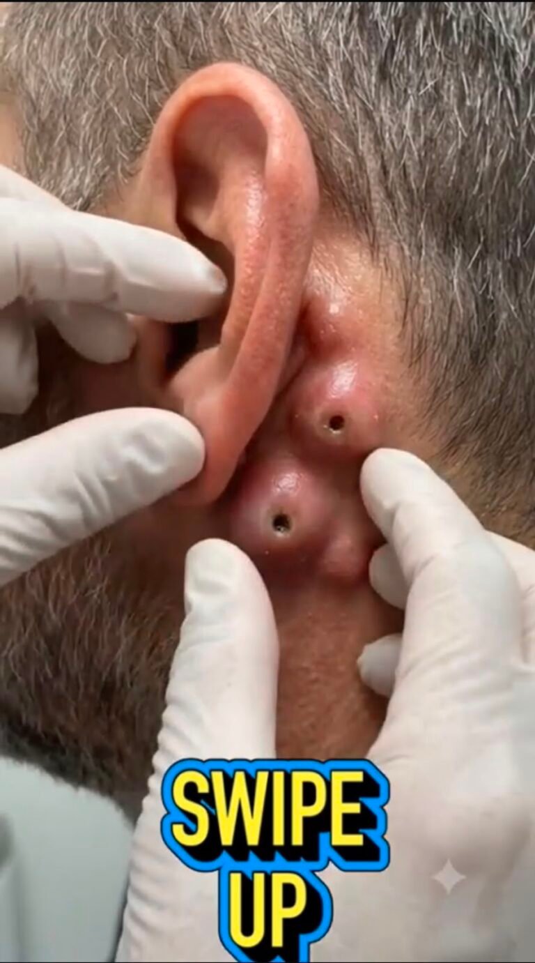Two Painful Lumps Behind the Ear? Understanding Infected Sebaceous (Epidermoid) Cysts