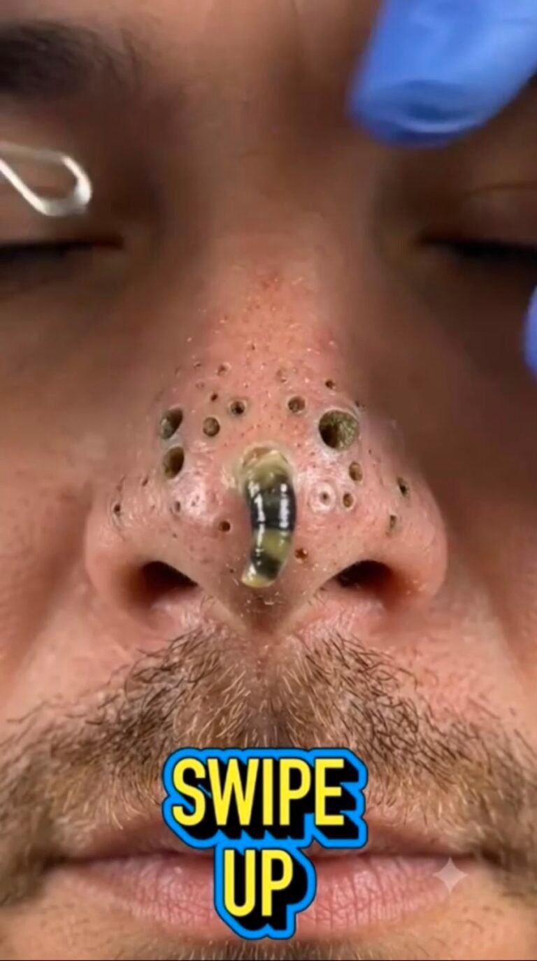 What Happens When a Giant Blackhead Is Finally Removed? Causes, Treatment, and Prevention