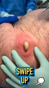 Giant Inflamed Skin Cyst: Causes, Symptoms, Safe Treatment, and Recovery Guide