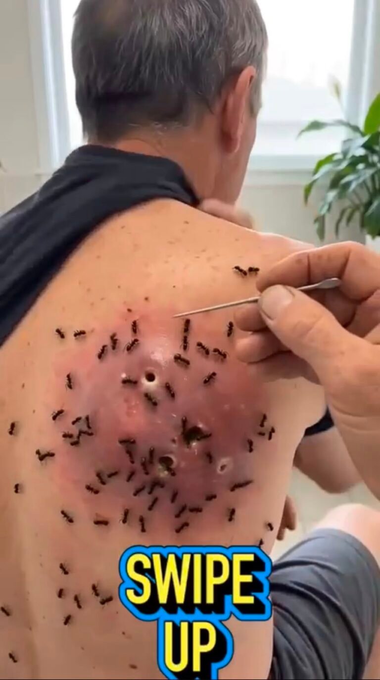 Giant Infected Skin Abscess: Causes, Symptoms, Treatment, and Prevention