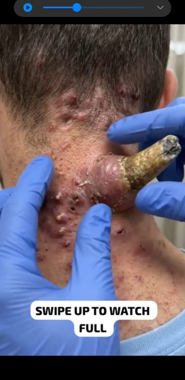 A Severe Scalp Infection Can Become More Complicated Than It Looks: Causes, Warning Signs & Professional Treatment