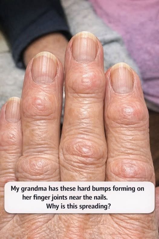 grandma has these hard bumps