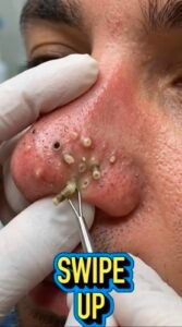 😳 What Are Those White Plugs Coming Out of the Nose? The Surprising Truth Behind Deep Clogged Pores