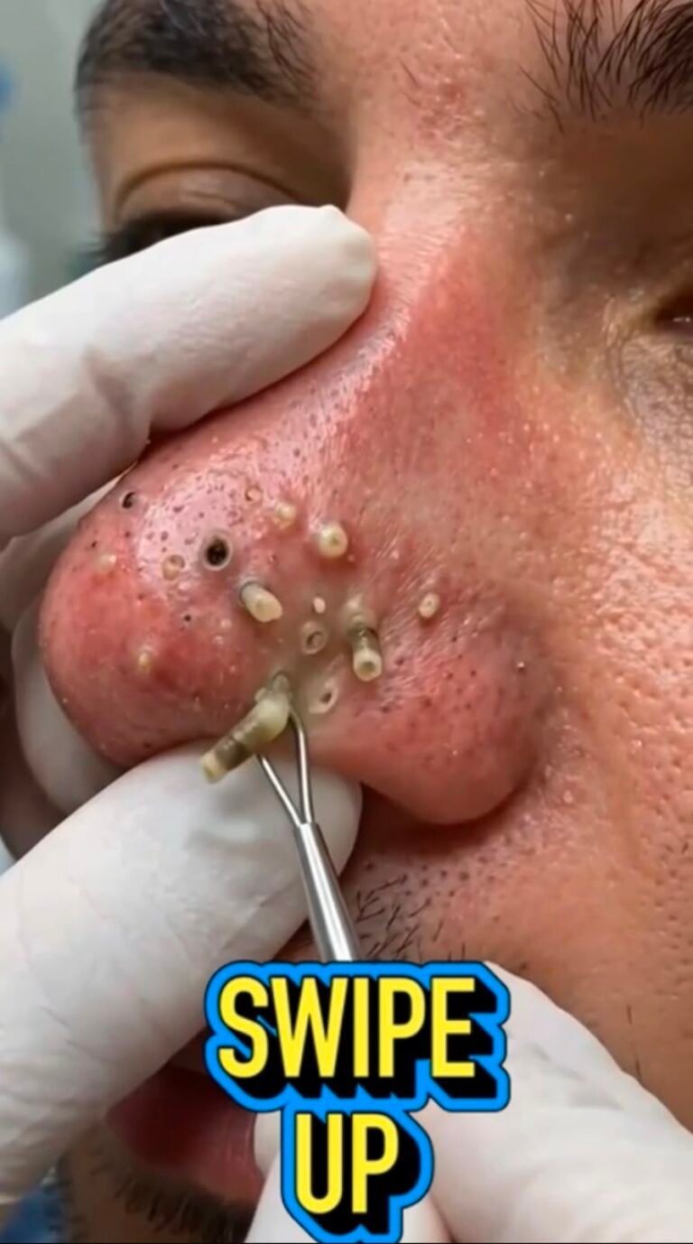 😳 What Are Those White Plugs Coming Out of the Nose? The Surprising Truth Behind Deep Clogged Pores