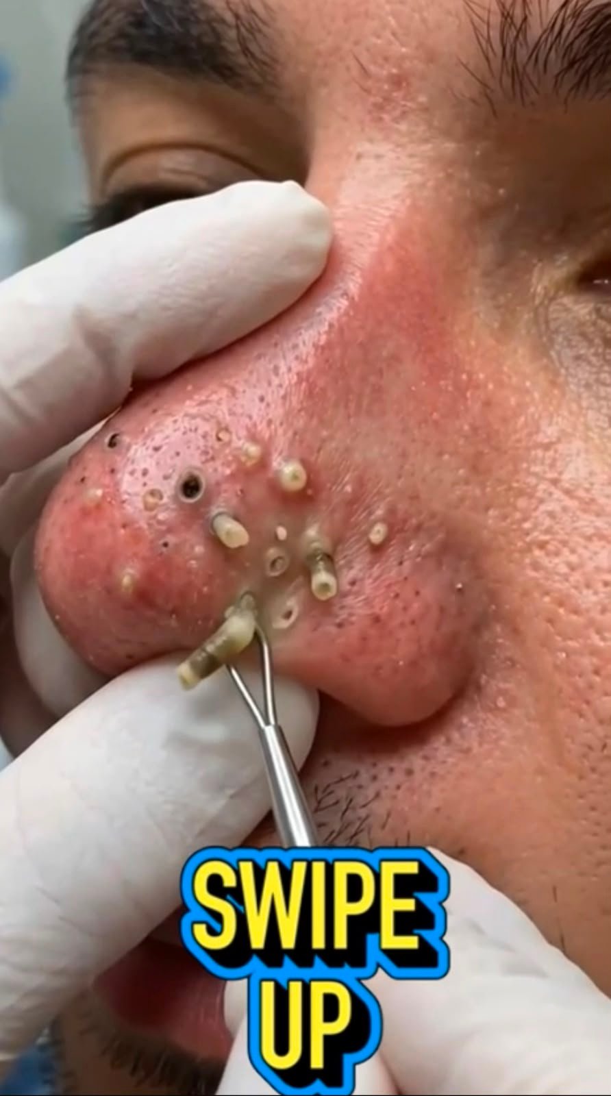 😳 What Are Those White Plugs Coming Out of the Nose? The Surprising Truth Behind Deep Clogged Pores