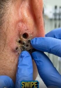 😳 The Mysterious Bumps Behind the Ear: What Could Be Hiding Beneath the Skin?