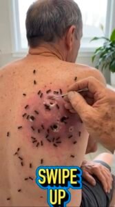 🐜 What’s Really Happening in This Shocking Back-Skin Image? Understanding Insect-Like Skin Lesions