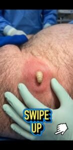 A Shocking Skin Lesion: What Could Be Emerging From This Inflamed Bump?
