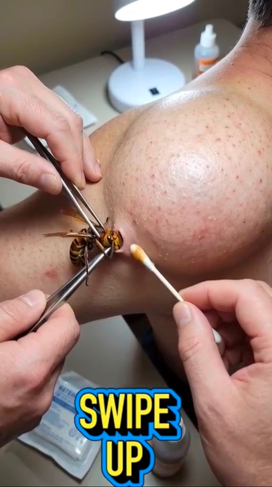 When a Bee or Wasp Sting Leaves a Dramatic Skin Reaction: What You Should Know