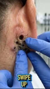 The Surprising Skin Problem Hiding Around the Ear: What Those Dark Openings May Mean