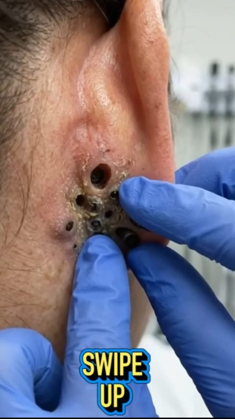 The Surprising Skin Problem Hiding Around the Ear: What Those Dark Openings May Mean