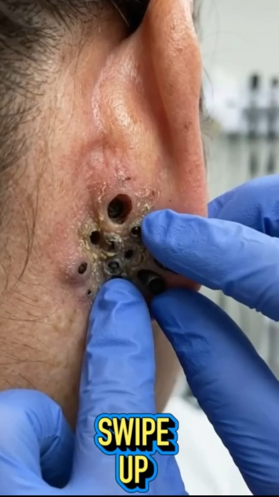 The Surprising Skin Problem Hiding Around the Ear: What Those Dark Openings May Mean