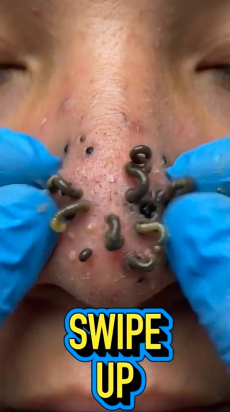 Something Unusual Was Emerging From the Nose — Here’s What This Shocking Image Could Mean