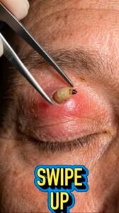 A Shocking Discovery on the Eyelid: When an Unusual Larva Appears Near the Eye