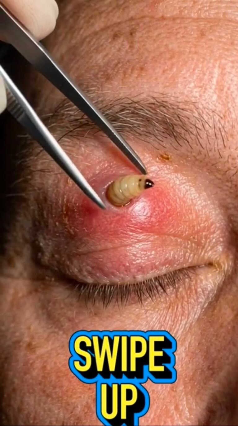 A Shocking Discovery on the Eyelid: When an Unusual Larva Appears Near the Eye