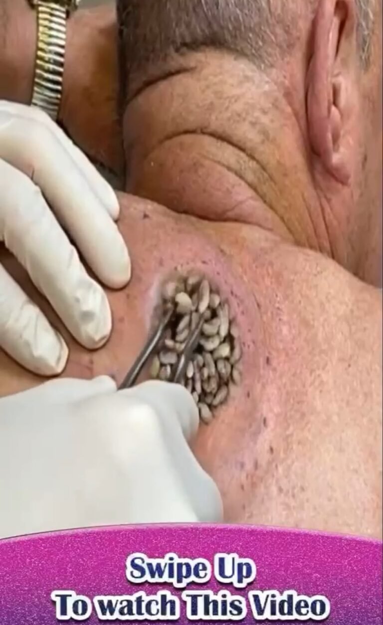 How to Safely Handle a Cluster of Engorged Ticks on the Back
