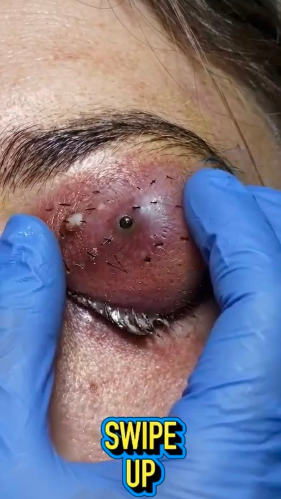 A Severe Eyelid Swelling With a Dark Central Opening: What Could Be Happening?