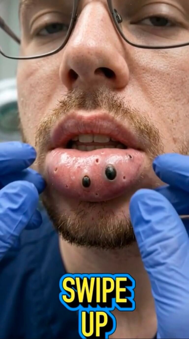 The Strange Bumps on the Lip: What Could Cause Them and When to Seek Medical Care