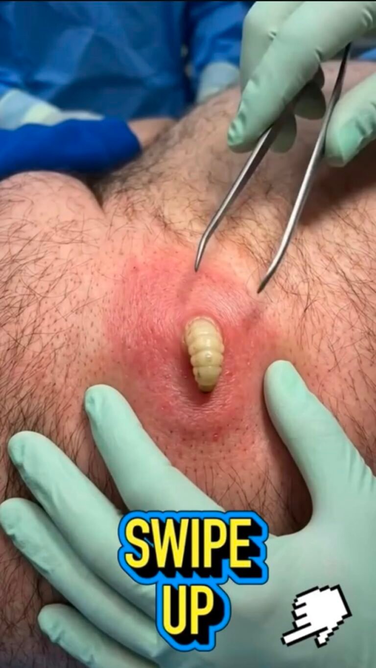 A Shocking Skin Infestation: What Happens When a Larva Develops Beneath the Skin?