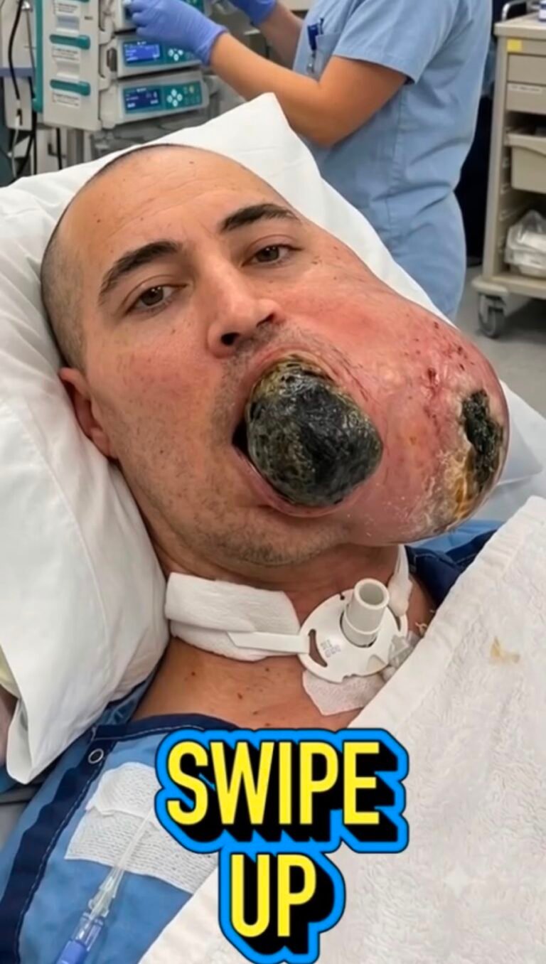 The Alarming Facial Swelling in This Image: What Could Cause Severe Lip Lesions?
