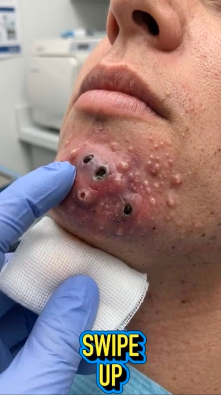 The Unusual Chin Lesions That Look Alarming: What Could Be Causing These Inflamed Bumps?