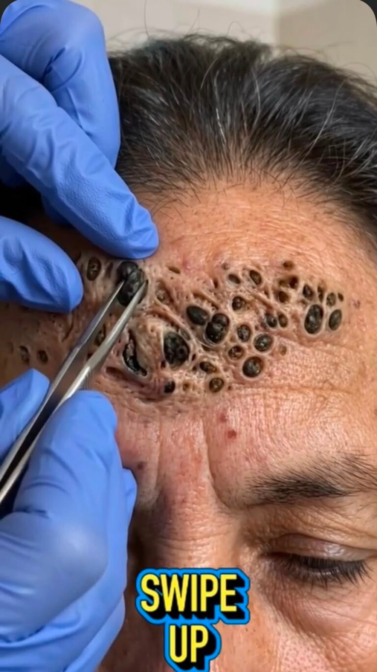 When Hundreds of Dark Plugs Cover the Skin: What Could Be Happening in This Unusual Dermatology Case?