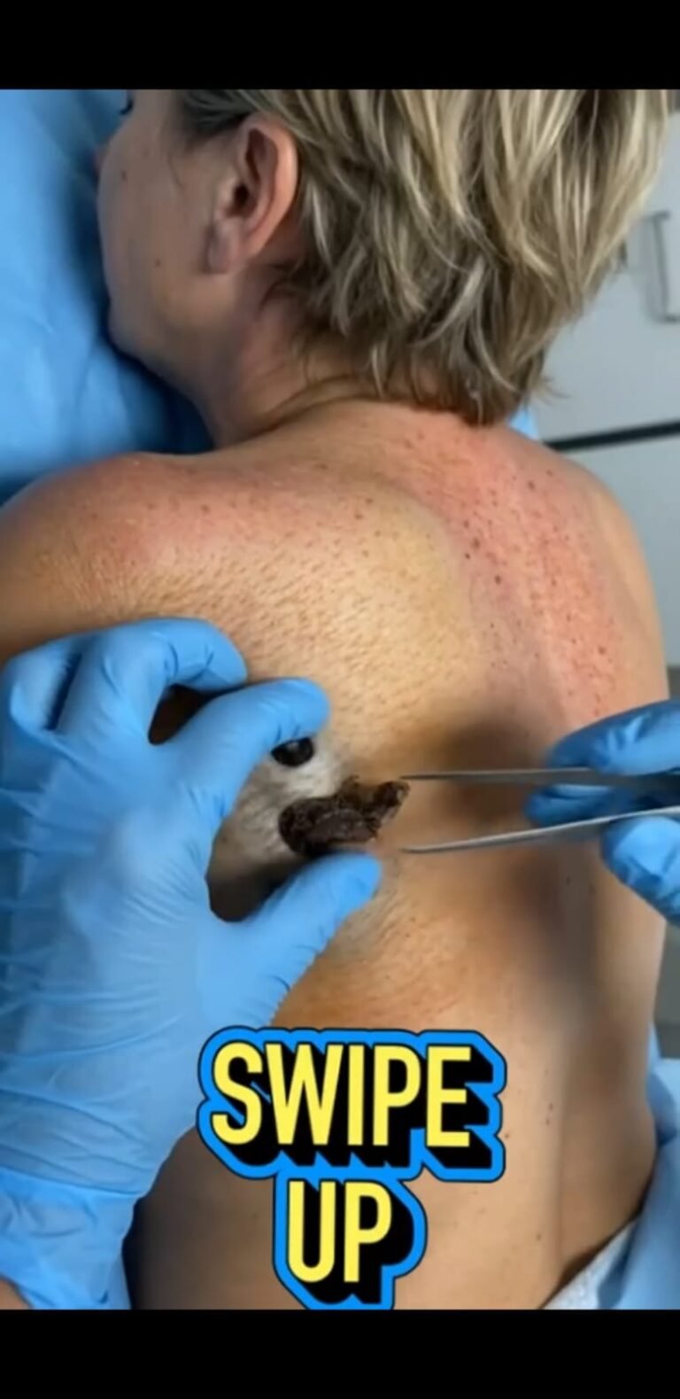 The Unusual Skin Growth on the Back: What Could This Dark, Crusted Plug Be?