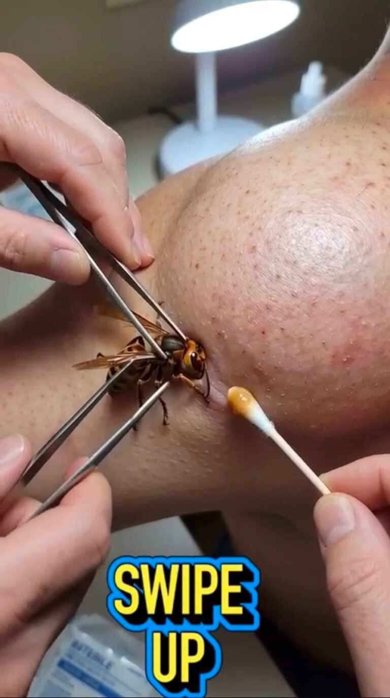When an Insect Becomes Embedded in the Skin: What This Unusual Image Reveals
