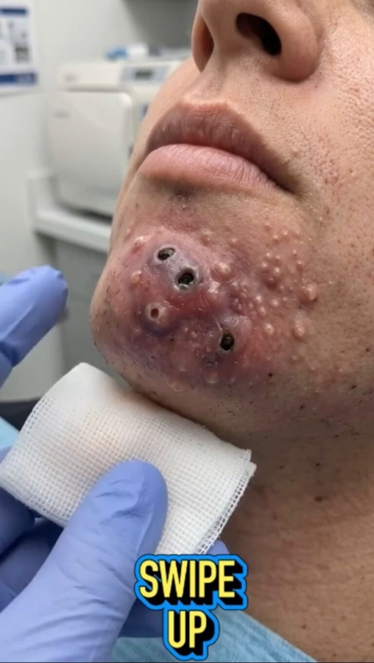 A Striking Chin Lesion: What Could Cause Multiple Inflamed Openings on the Skin?