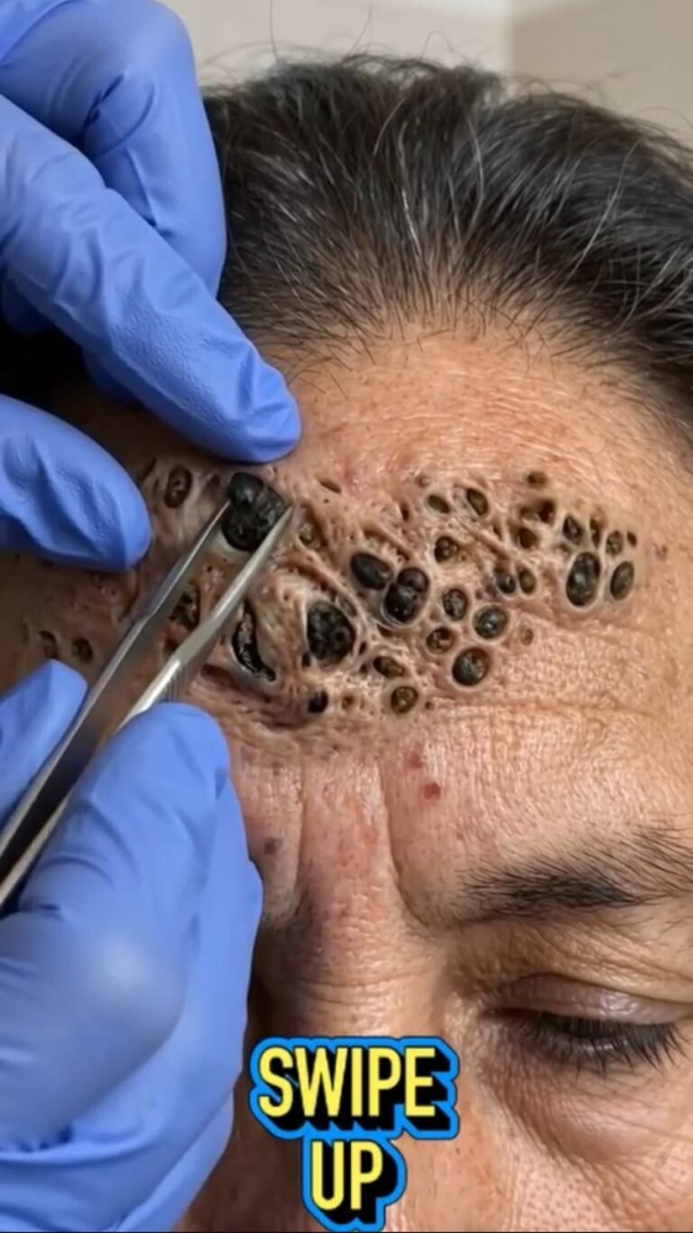 When Hundreds of Dark Plugs Cover the Skin: What Could Be Happening in This Unusual Dermatology