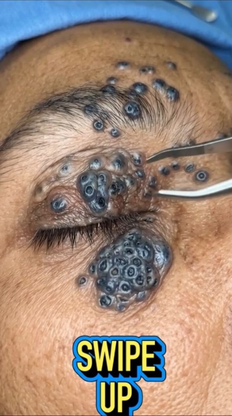 A Startling Close-Up: Why Are So Many Dark Plugs Appearing Around the Eye?