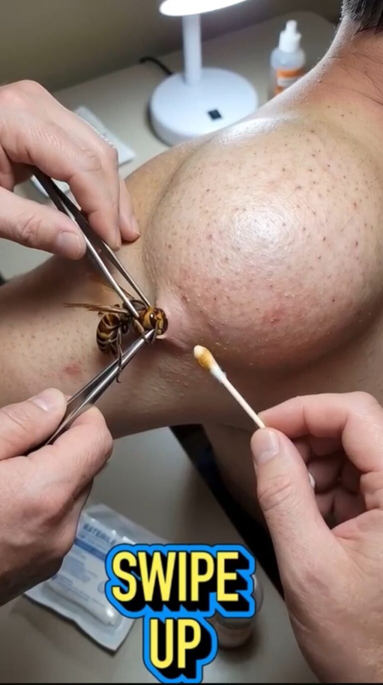 A Wasp Attached to the Skin: What Happens After an Unexpected Insect Sting?