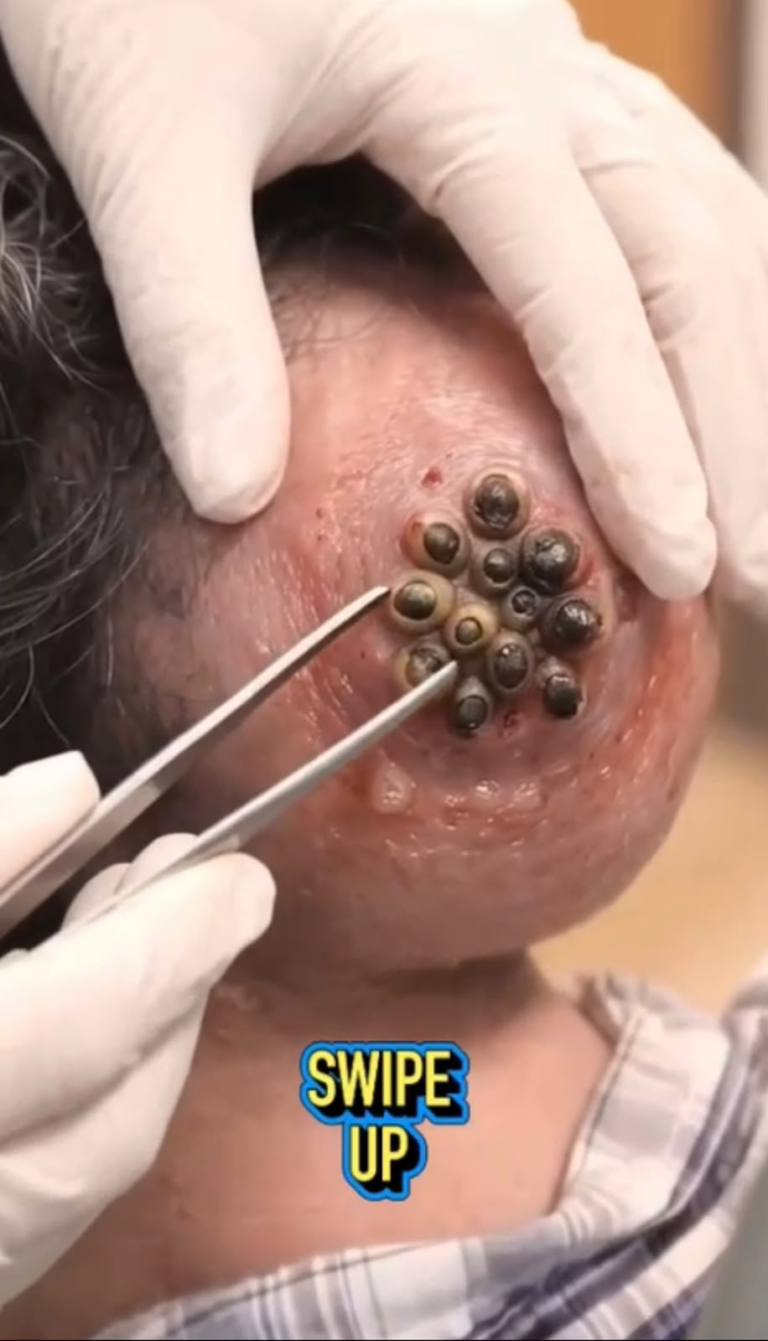 Multiple Ticks Around the Ear: Why Immediate Removal Matters