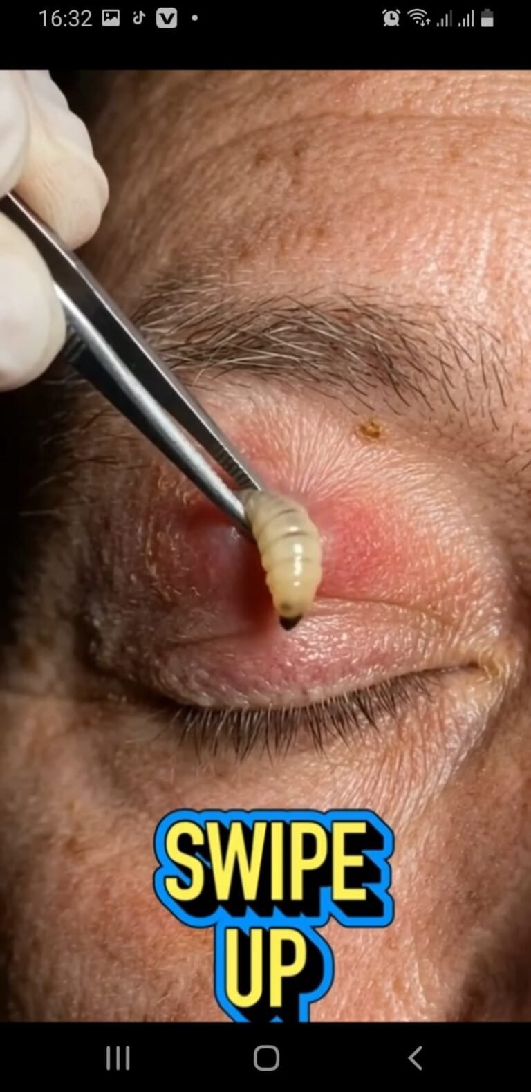 A Shocking Larva-Like Growth Removed From the Eyelid — What Could Be Happening?