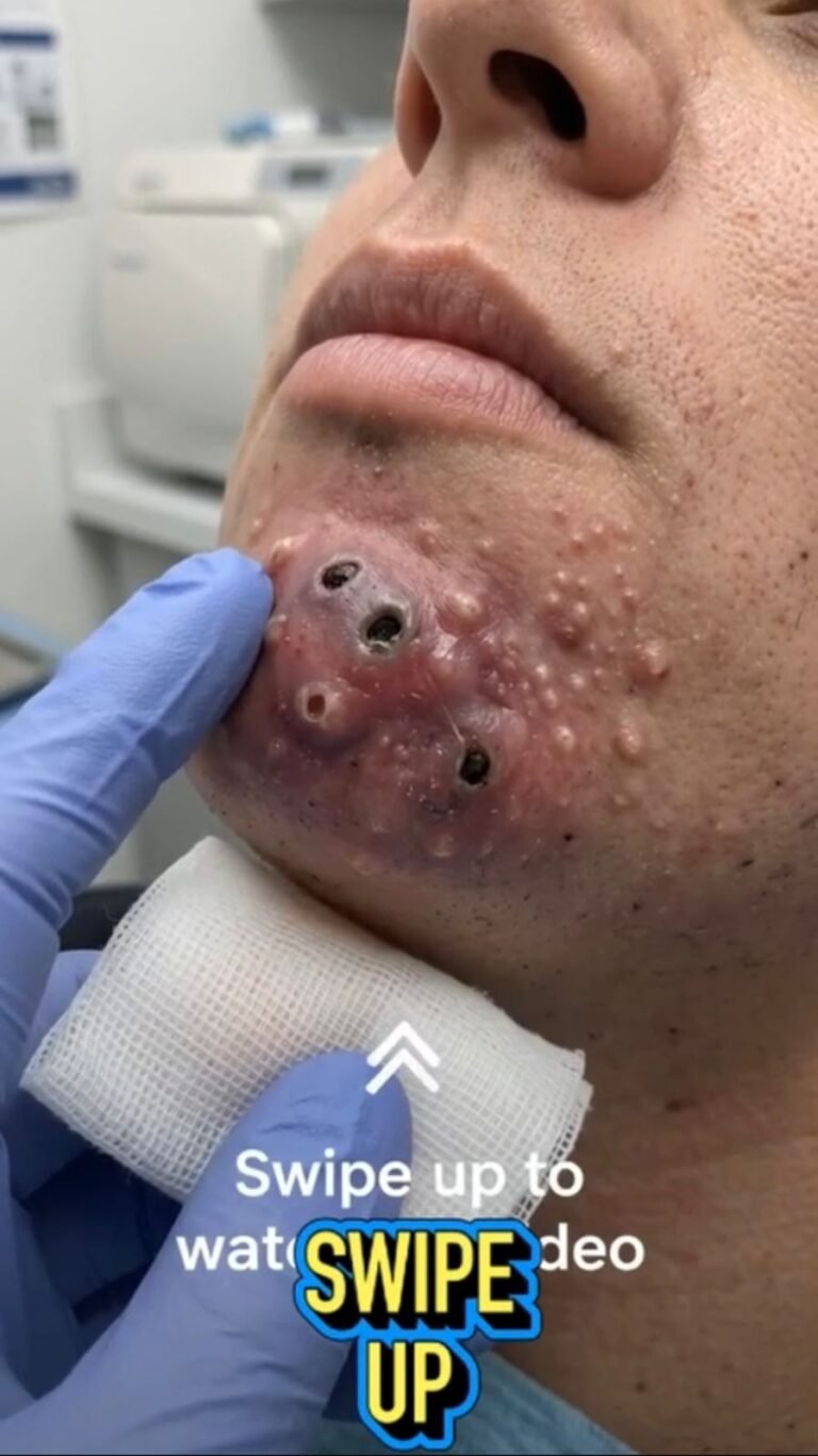 A Close Look at Severe Skin Lesions: What Could Cause Multiple Inflamed Openings on the Chin?