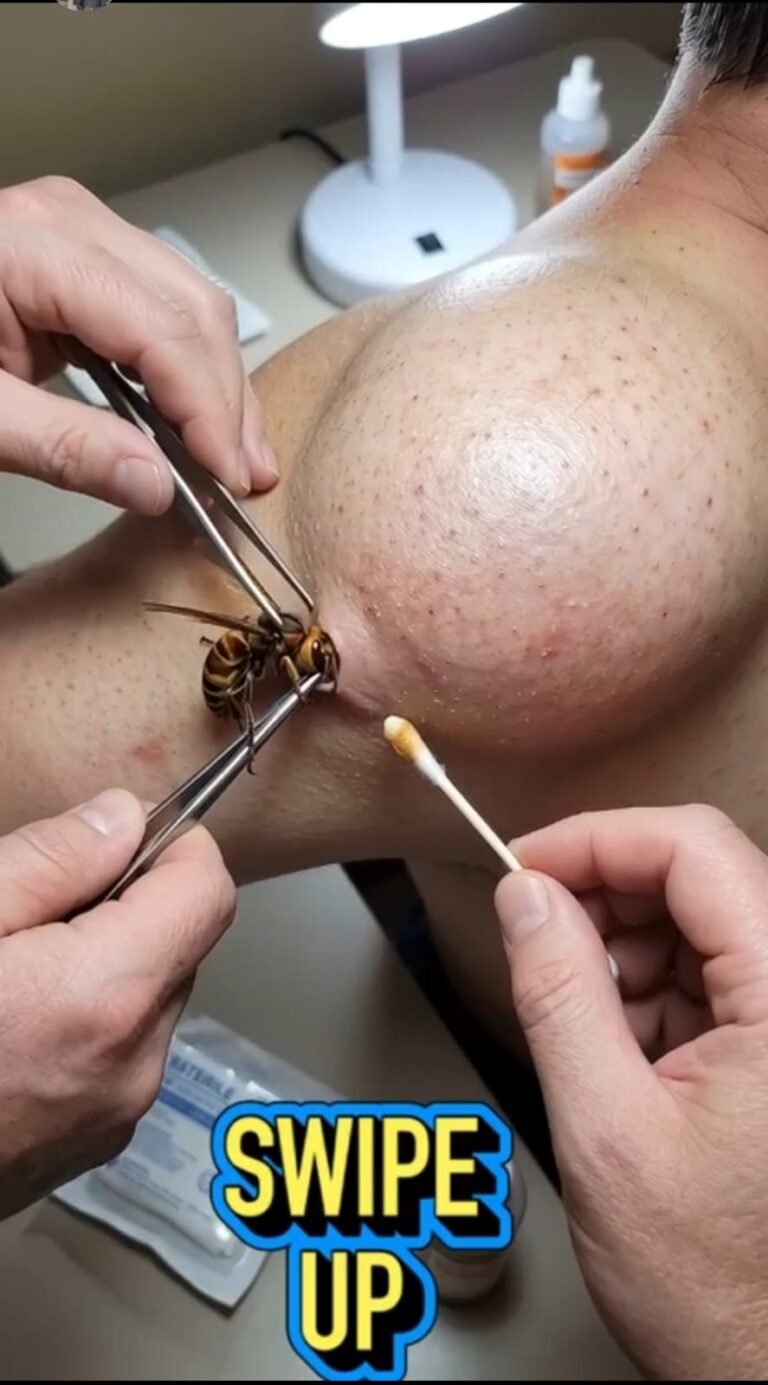 A Wasp Sting Can Become a Medical Emergency: What Happens When a Stinger Is Left in the Skin?