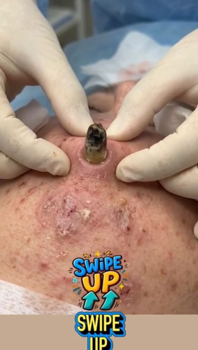 A Shocking Skin Case: What Can Happen When an Unusual Foreign Object Becomes Embedded in the Skin