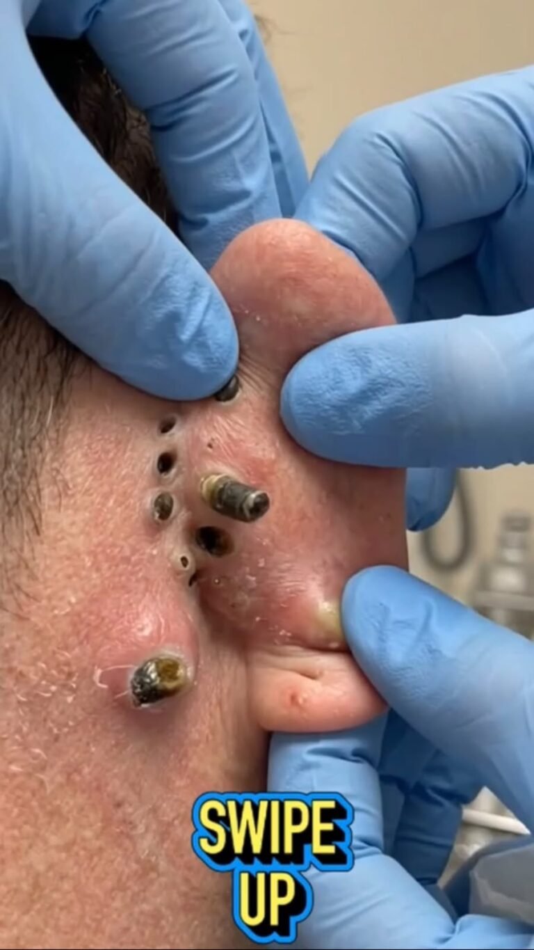 Multiple Dark Growths on the Skin: What Could Cause This Unusual Appearance?