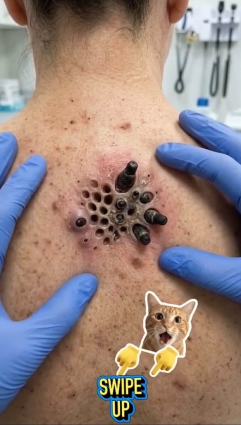 A Shocking Skin Lesion With Multiple Openings: What Could Cause an Appearance Like This?