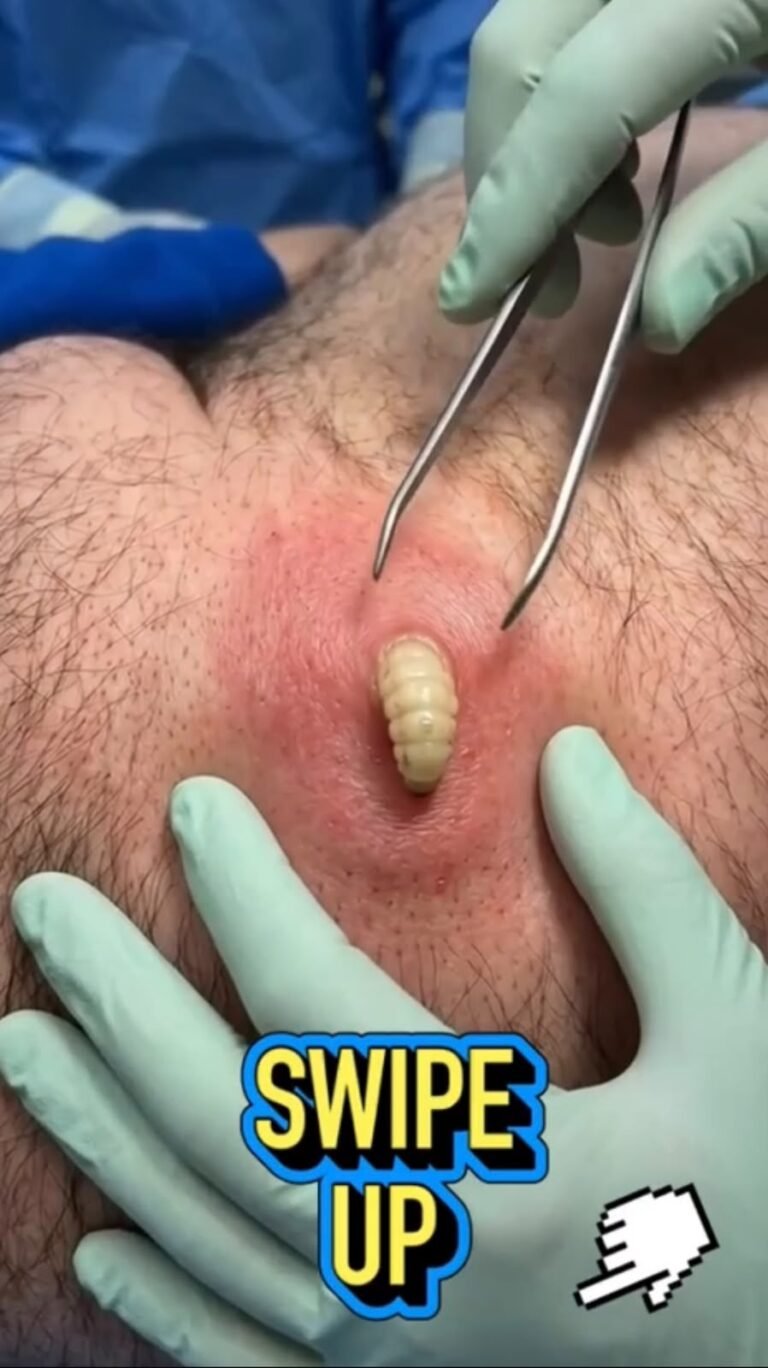 A Shocking Larva-Like Growth Removed From the Eyelid — What Could Be Happening?