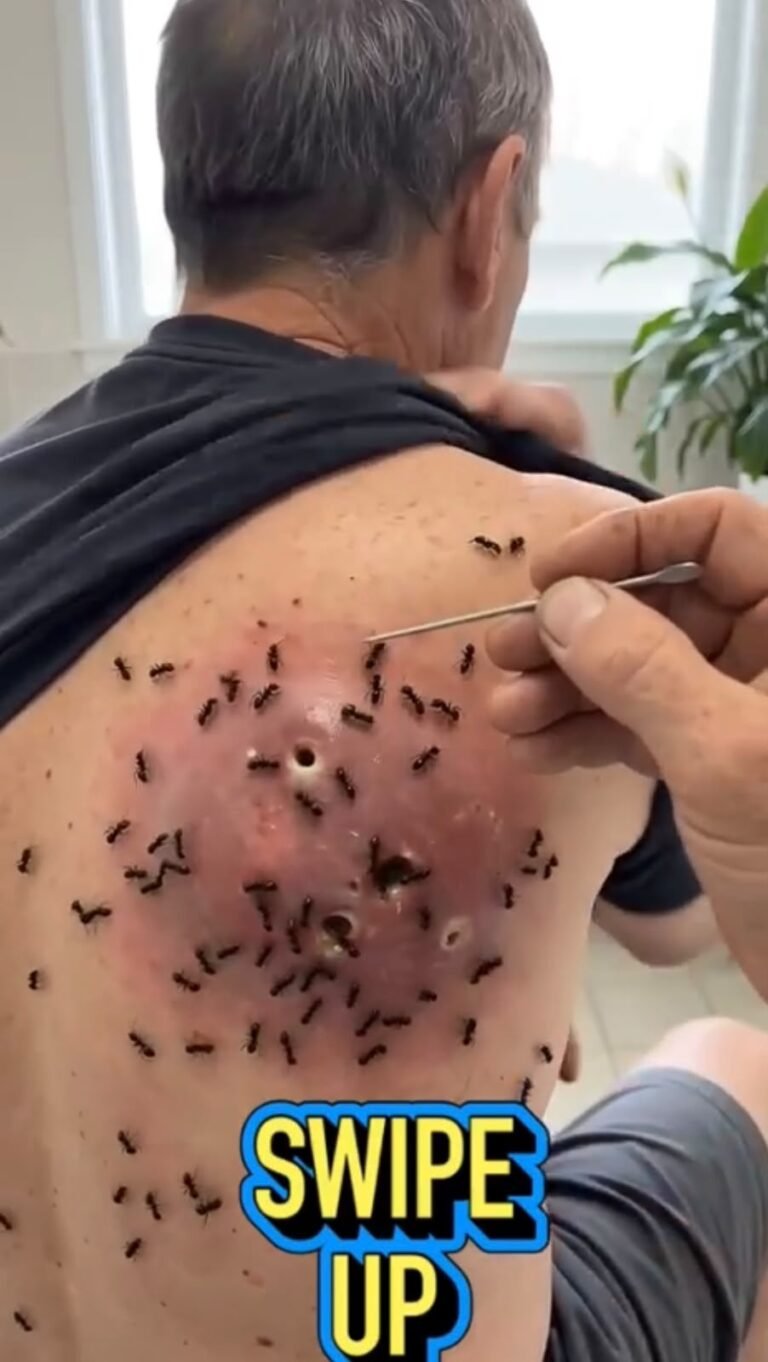 A Severe Skin Wound With Multiple Larvae: Why Immediate Medical Care Matters